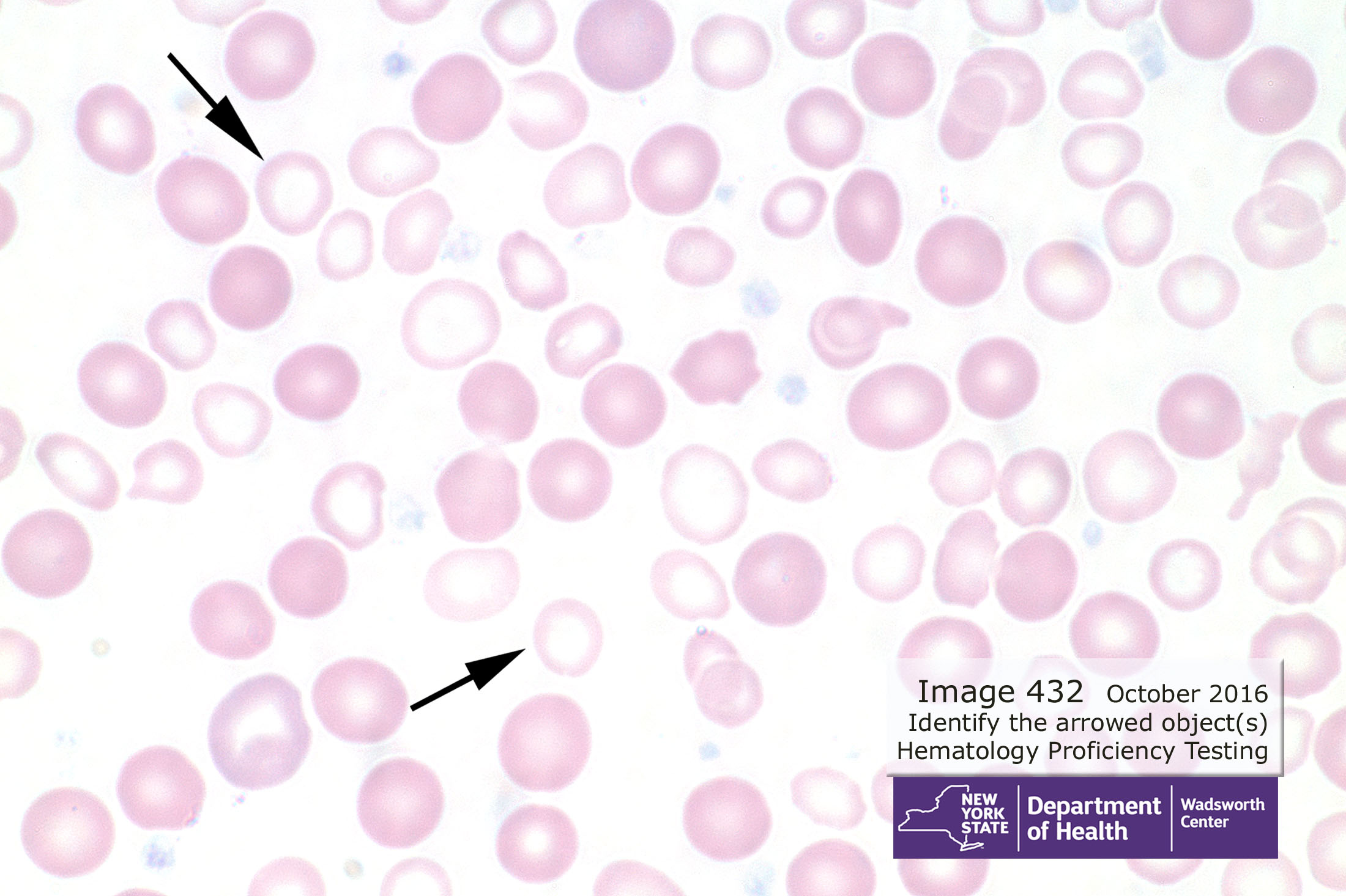 Hematology Image 432